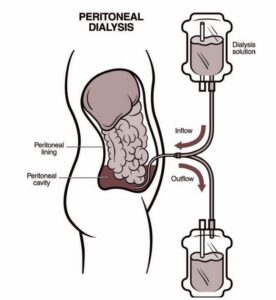 dialysis