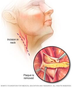 carotid artery disease treatment