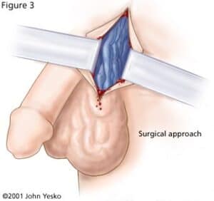 varicocele treatment singapore