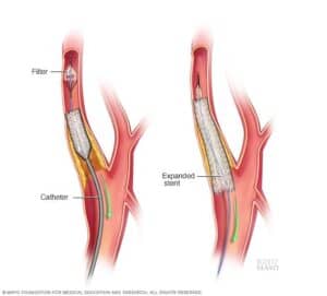 carotid artery disease treatment