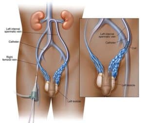 varicocele treatment singapore