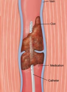 deep vein thrombosis treatment singapore