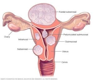 benign tumor treatment