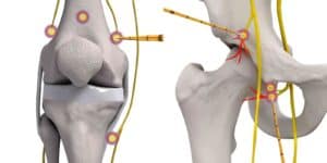 radiofrequency for pain treatment singapore