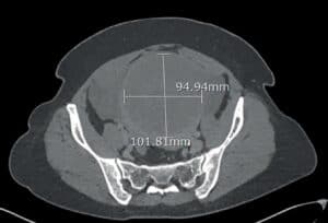 benign tumor treatment