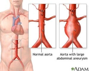 vascular disease treatment singapore