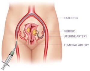 benign tumor treatment