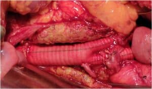 aortic aneurysm treatment singapore