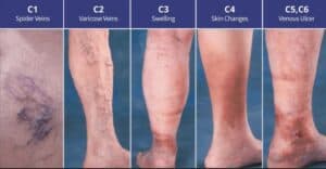vascular disease treatment singapore