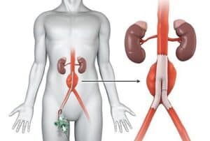 aortic aneurysm treatment singapore