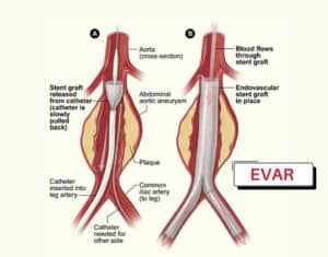 abdominal aortic aneurysm treatment singgapore