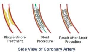vascular disease treatment singapore