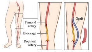 vascular disease treatment singapore