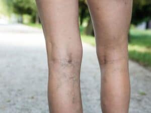 sclerotherapy singapore