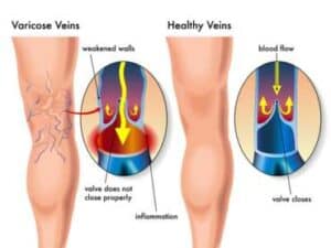 sclerotherapy singapore