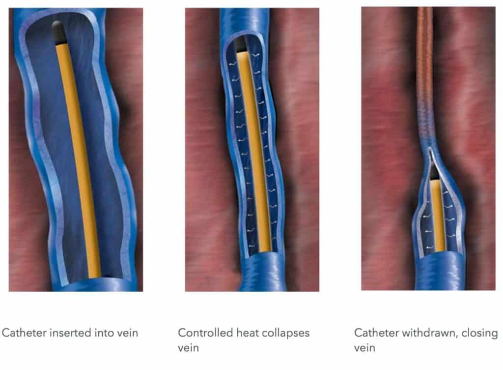 sclerotherapy singapore
