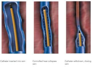 sclerotherapy singapore