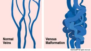 venous malformation brain treatment singapore
