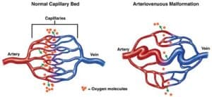 arteriovenous malformation s treatment singapore