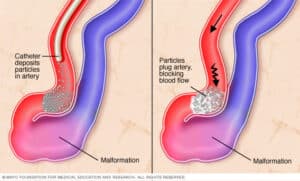 arteriovenous malformation s treatment singapore
