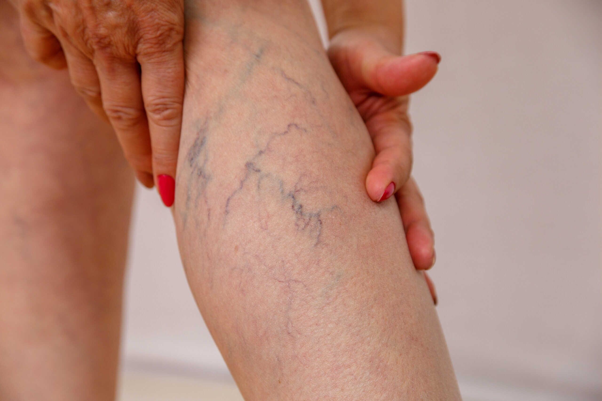 新品　VITA-K SPIDER VEINS クモ静脈の外観減、小じわ減少 elderly-woman-white-panties-