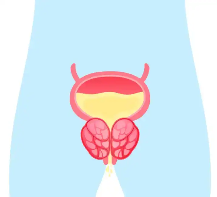 Enlarged Prostate Diagram